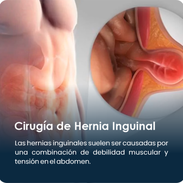 Cirugia_de_Hernia_Inguinal_1