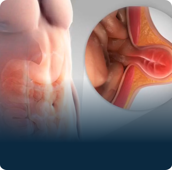 Cirugia_de_Hernia_Inguinal_1